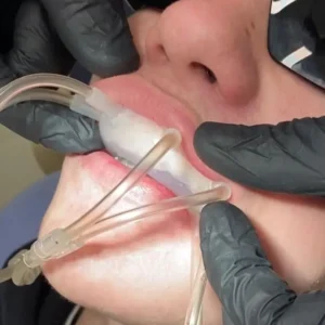 Curso Moldeira Ozonioterapia para Boca