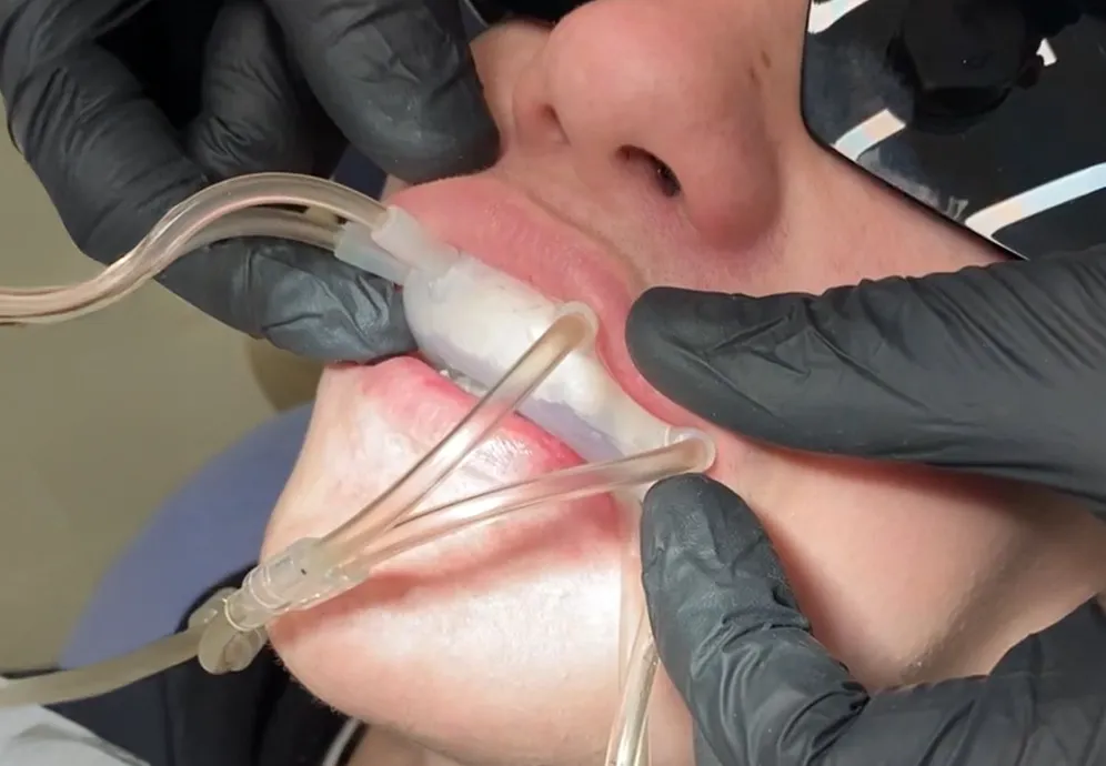 Curso Moldeira Ozonioterapia para Boca